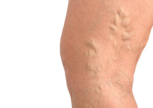 varicose veins in leg