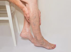 peripheral arterial disease in legs