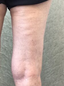 spider veins in patient leg after treatment