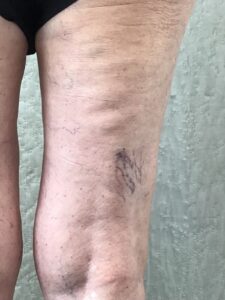 spider veins in patient leg before treatment