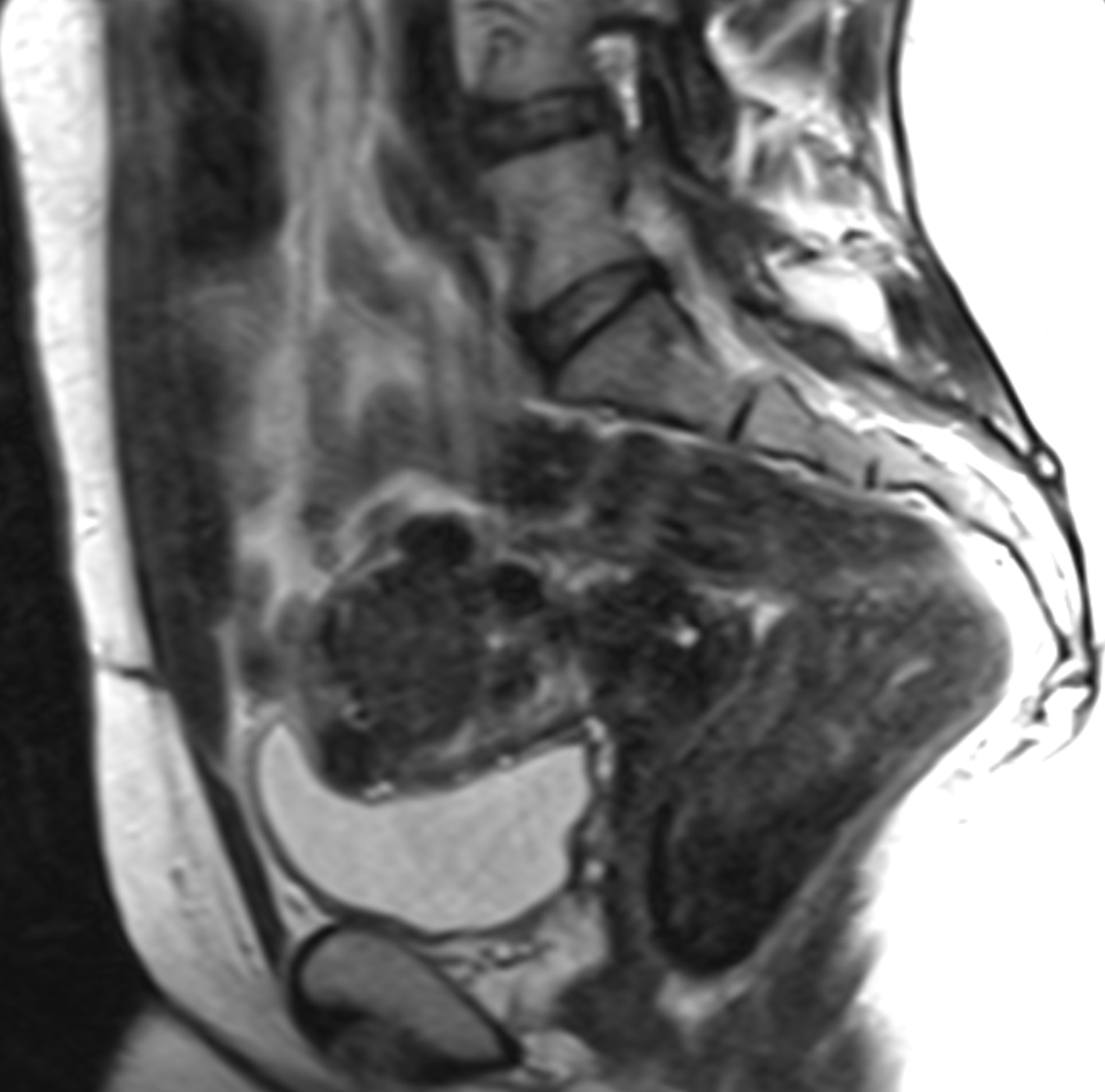 uterine-fibroid-ufe-1-before | Zenith Vascular & Fibroid Center