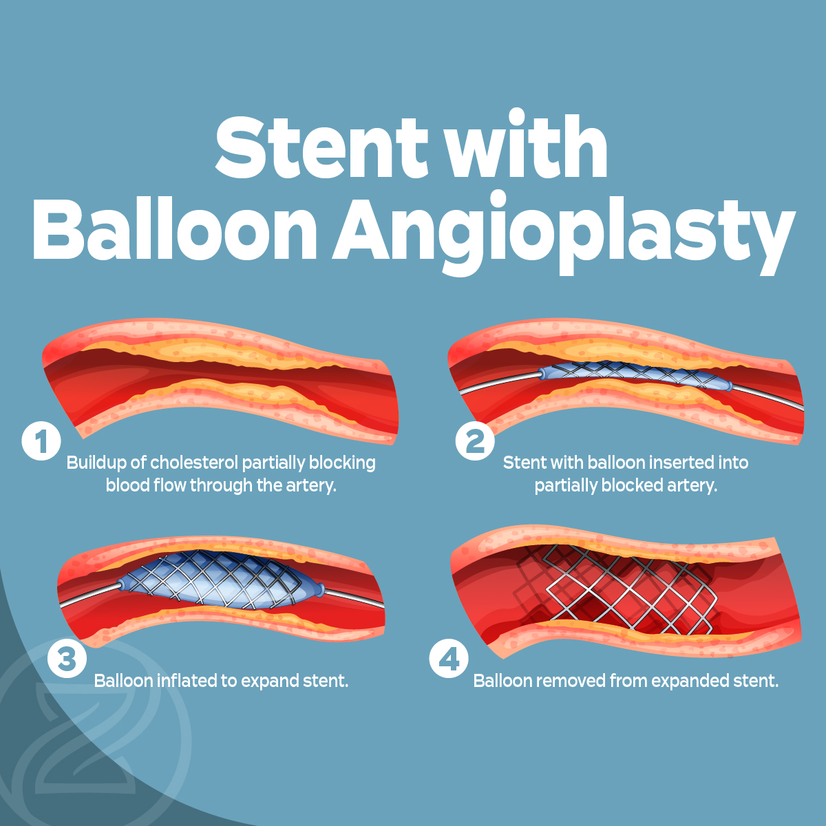 zenith vascular balloon angioplasty