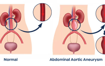 Causes and Risk factors of Abdominal Aortic Aneurysm (AAA)