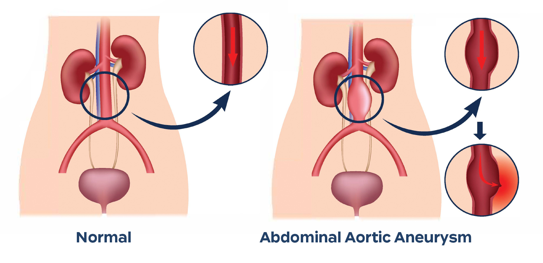 abdominal aortic aneurysm AAA rupture