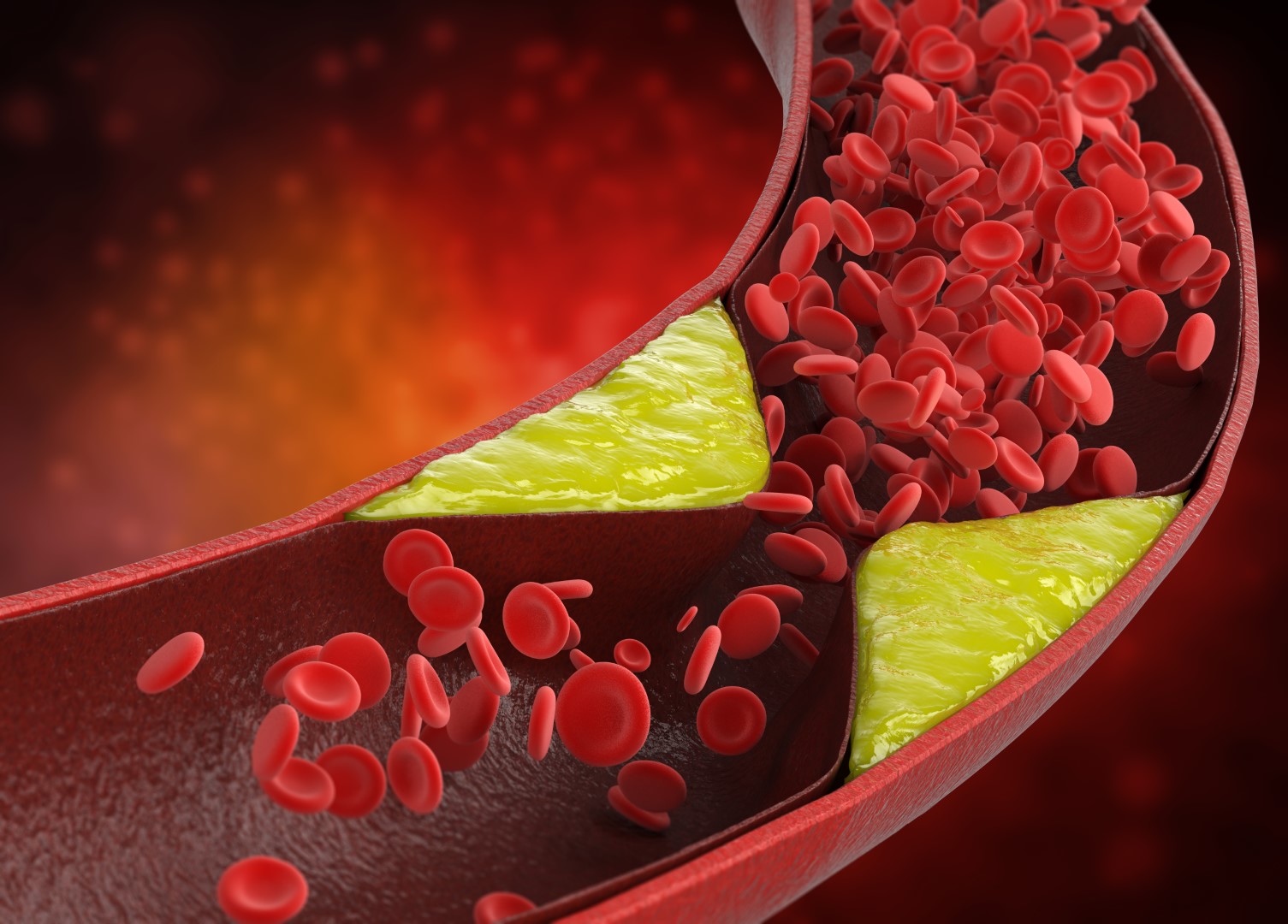 arterial blockages