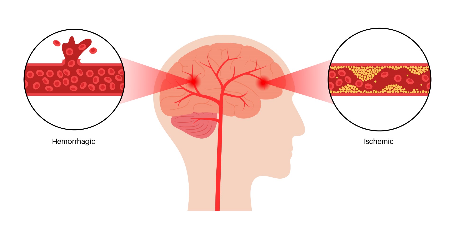 carotid artery disease ishemic and hemorrhagic