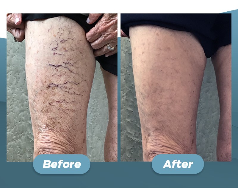 endovenous laser treatment before and after picture