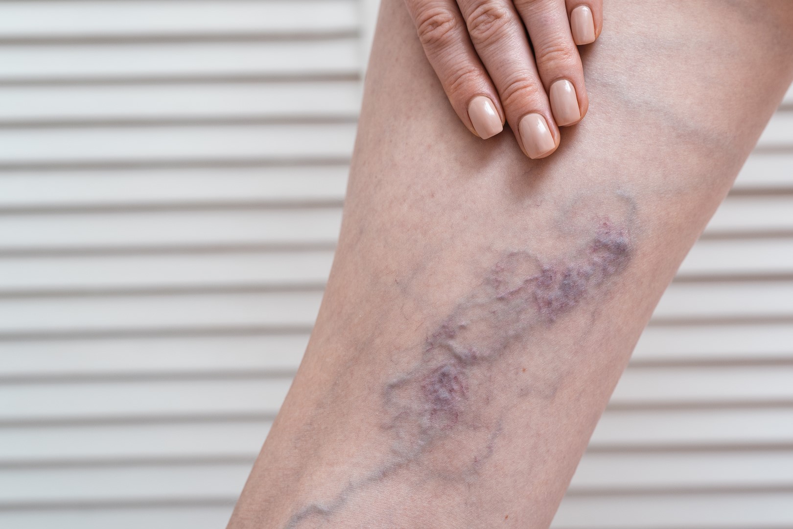 varicose veins in leg pain