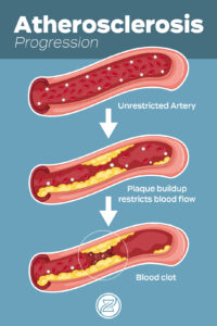 zenith vascular atherosclerosis progression chart