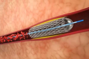 aortic aneurysm treatment in memphis tn sc