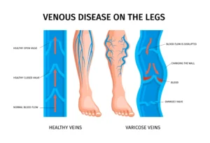 zenith vascular peripheral arterial disease scaled sc