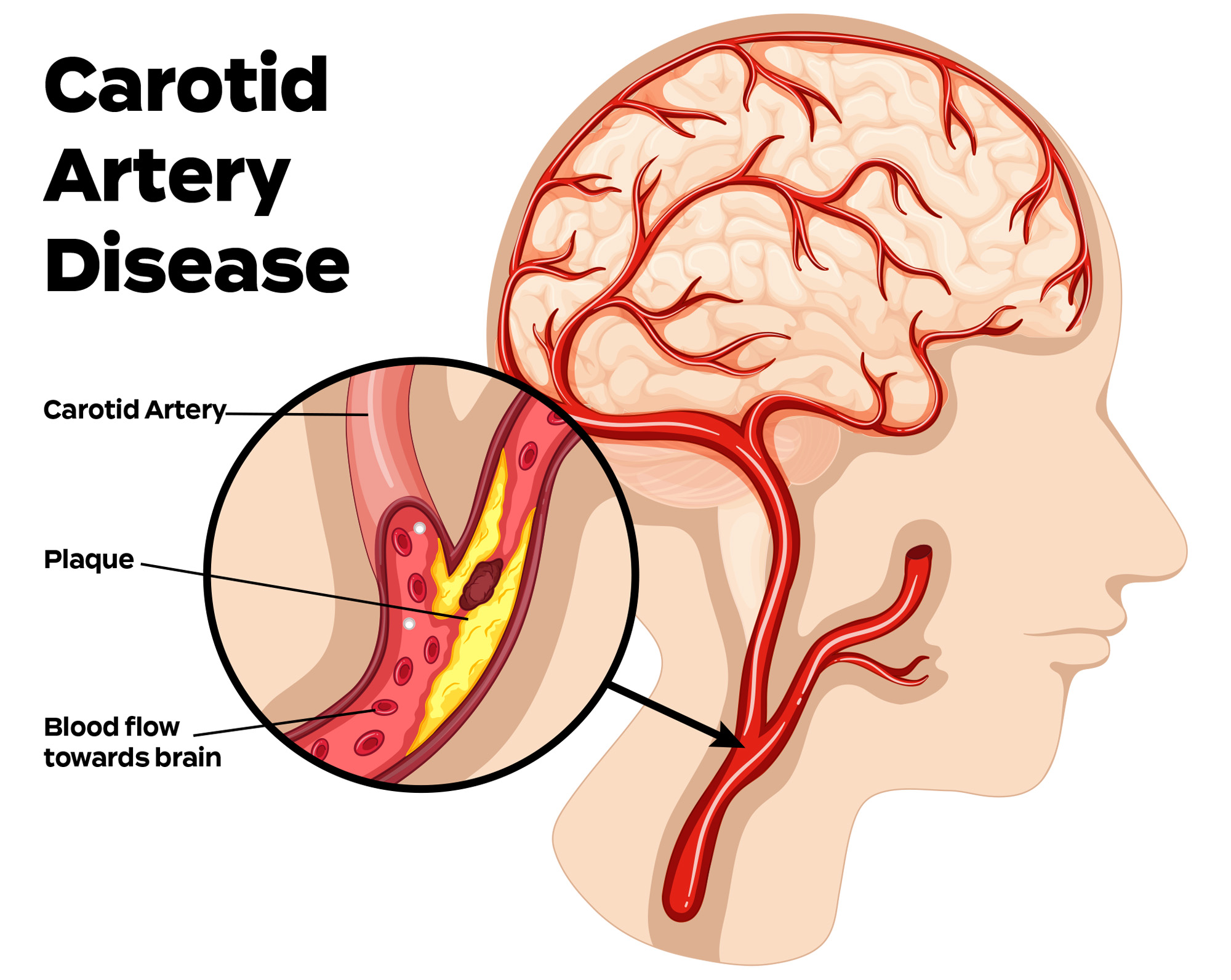 carotid artery disease diagram