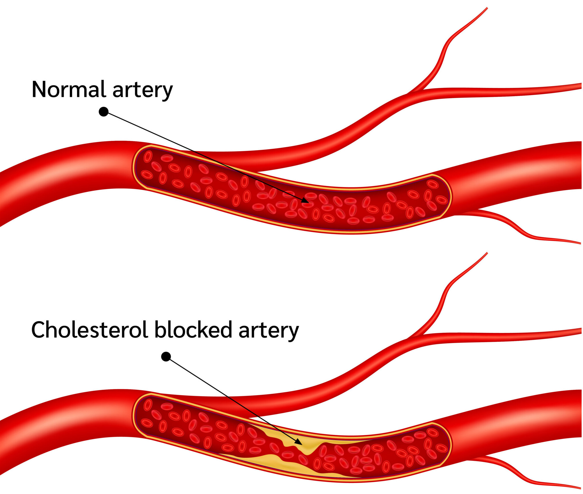 normal artery and cholesterol blocked artery