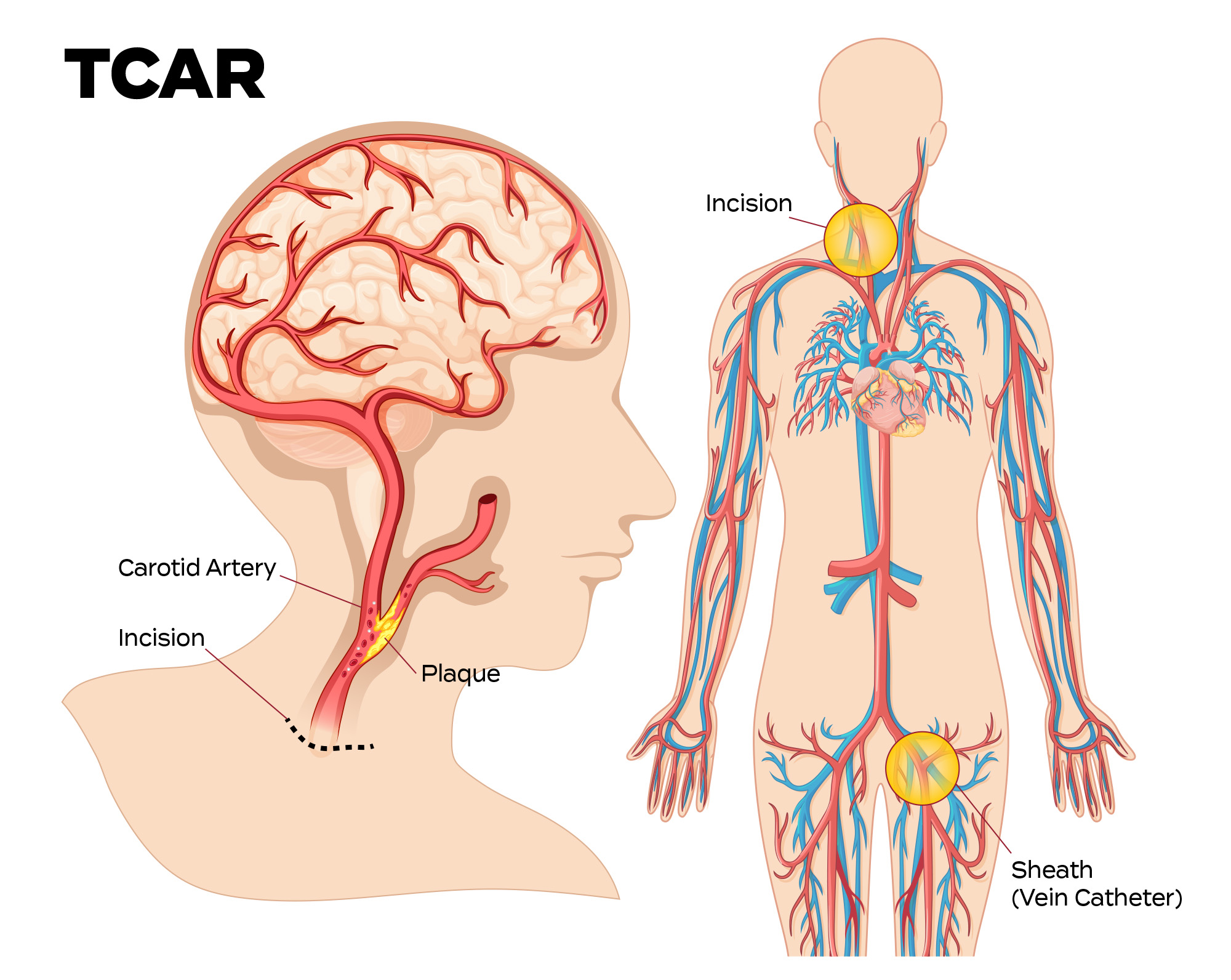 tcar procedure diagram