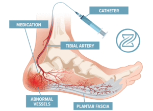 zenith vascular plantar fascia embolization diagram