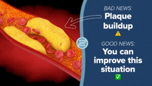 Bad news plaque buildup good news you can improve this situation