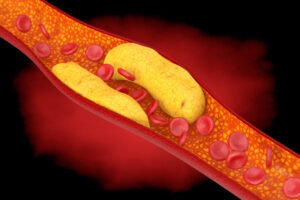 clogged artery web 1